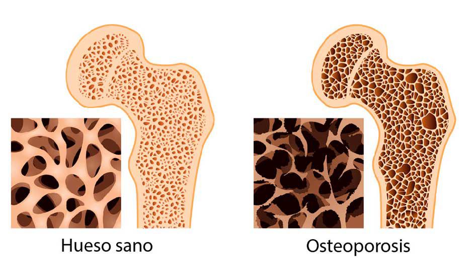 ¿Cómo prevenir la osteoporosis en la menopausia?