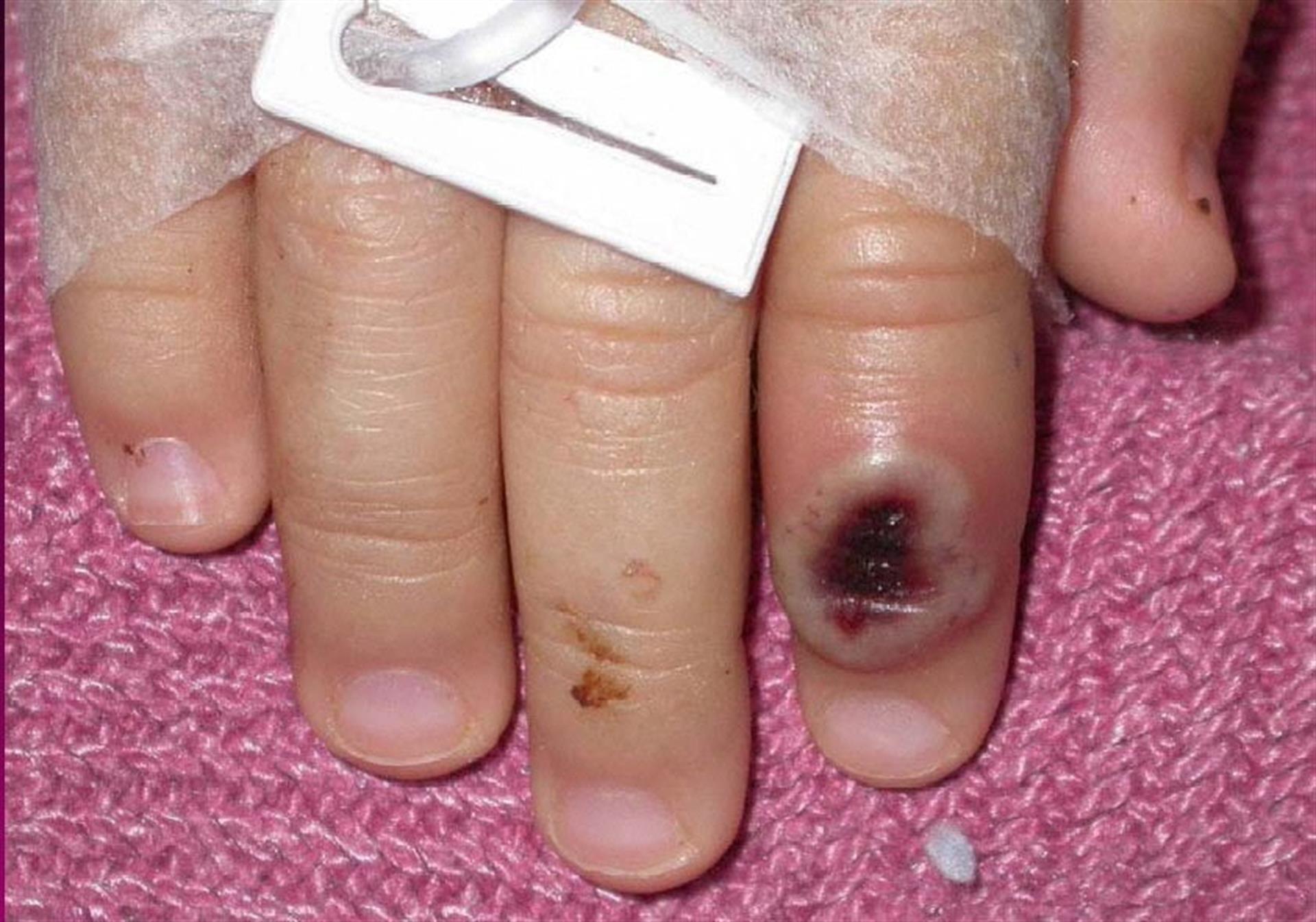Fotografía del Centro Estadounidense de Control de las Enfermedades (CDC) en la que se aprecia el dedo de un niño infectado por la llamada ”viruela de mono” (monkeypox). EFE/Cortesía CDC